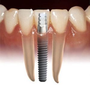 Dental Implants Norwalk CT